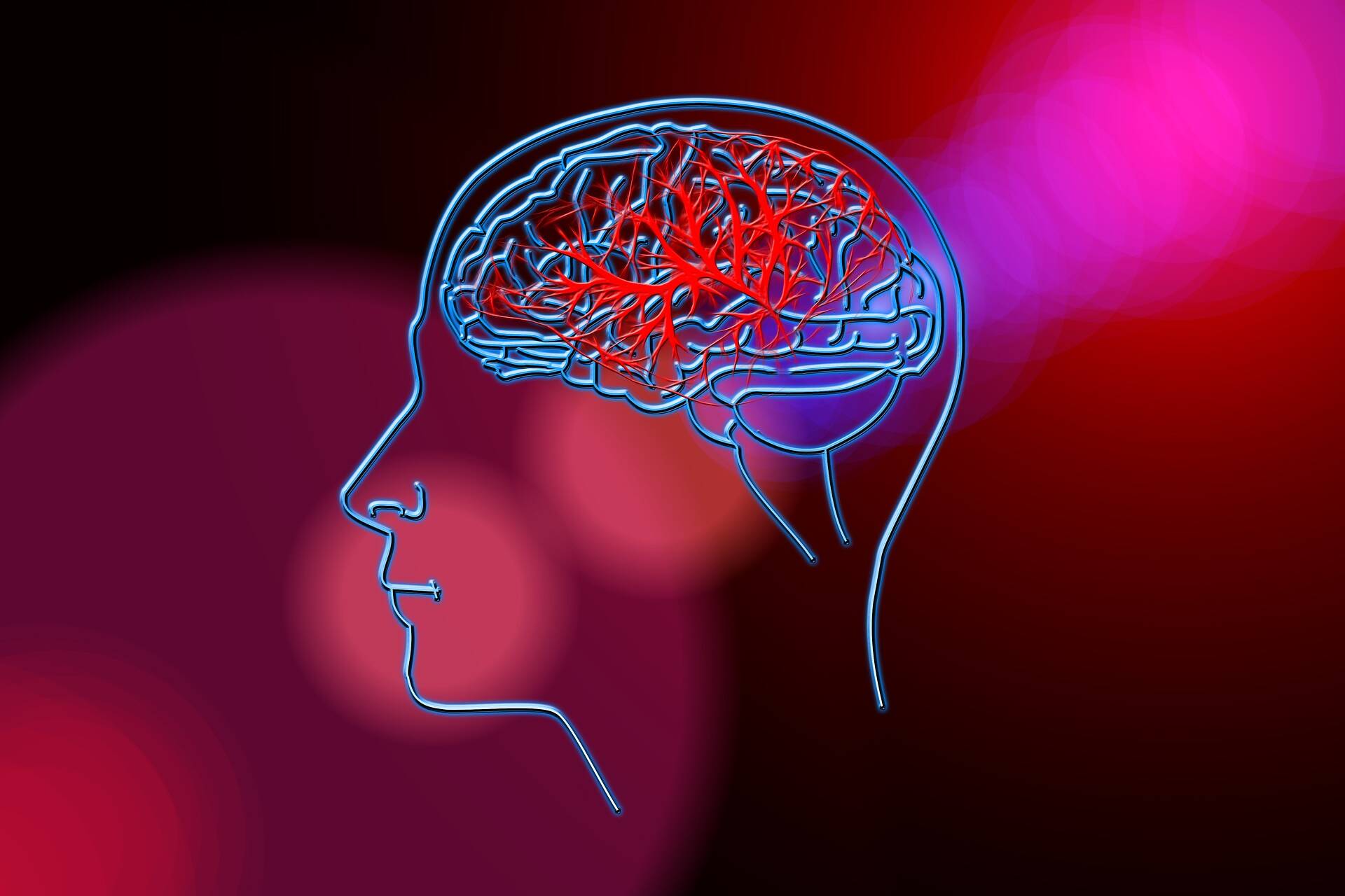 Stroke by Gerd Altmann from Pixabay 
